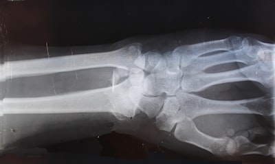Multiple fractures — множественные переломы