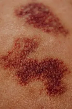 Bruise me — повреди меня