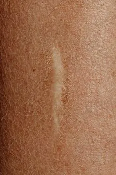 Astringent — Вяжущее