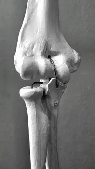 Sprains — Растяжения связок
