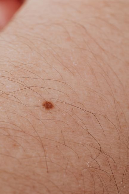Birthmark — родимое пятно