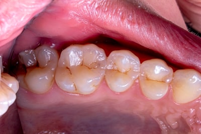 cavities — дырки в зубах