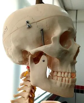Zygomatic arch — скуловая дуга